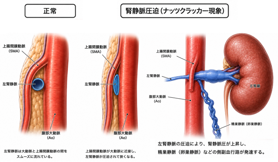 ナットクラッカー症候群